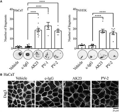 ST18 Enhances PV-IgG-Induced Loss of Keratinocyte Cohesion in Parallel to Increased ERK Activation